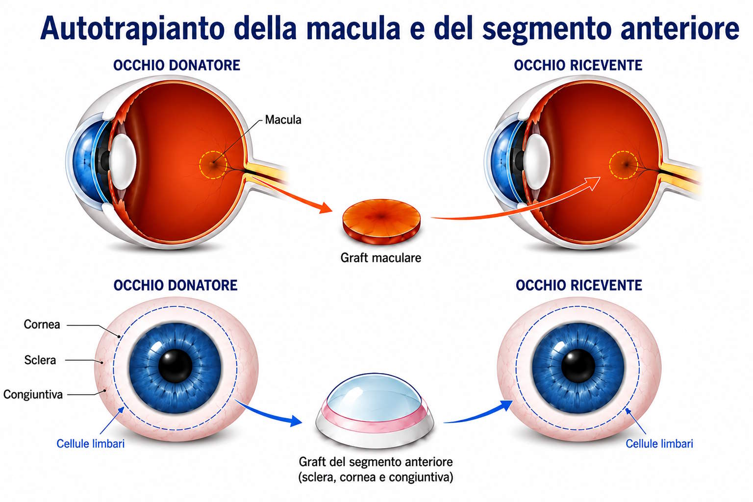 Autotrapianto del segmento anteriore dell'occhio e della macula retinica all'Ospedale Molinette : Primato mondiale per la sanità italiana.